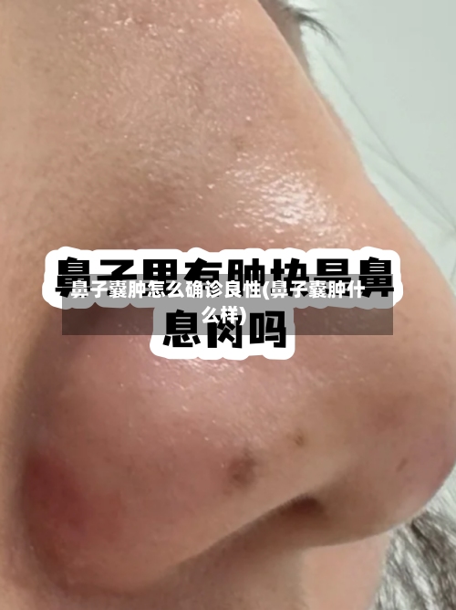 鼻子囊肿怎么确诊良性(鼻子囊肿什么样)-第1张图片