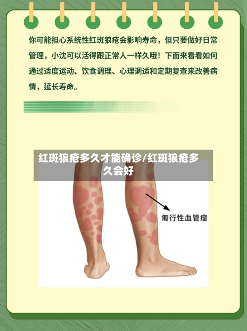 红斑狼疮多久才能确诊/红斑狼疮多久会好-第1张图片