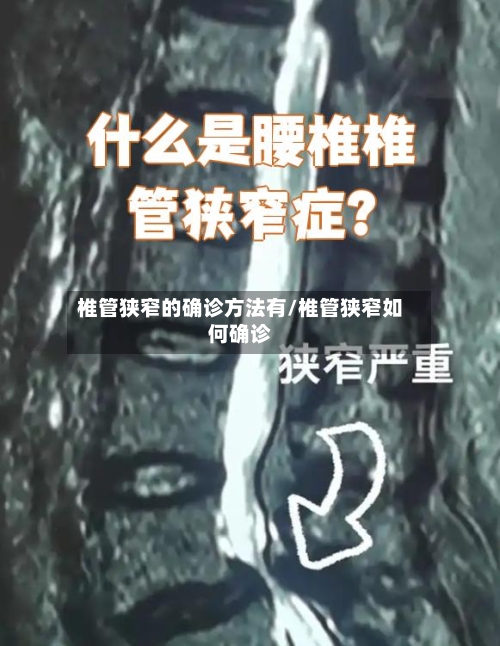 椎管狭窄的确诊方法有/椎管狭窄如何确诊-第1张图片