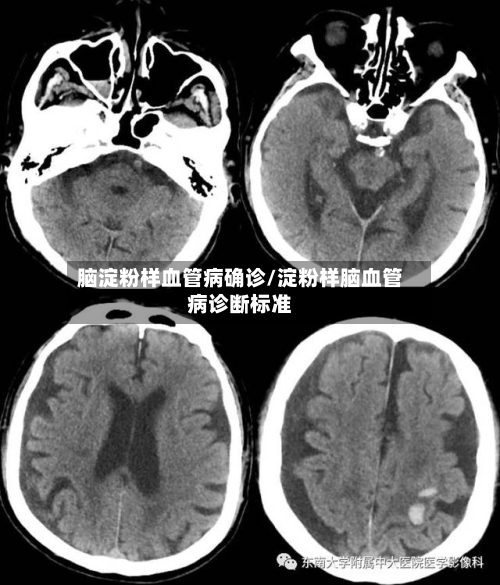 脑淀粉样血管病确诊/淀粉样脑血管病诊断标准-第3张图片