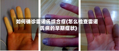 如何确诊雷诺氏综合症(怎么检查雷诺氏病的早期症状)-第2张图片