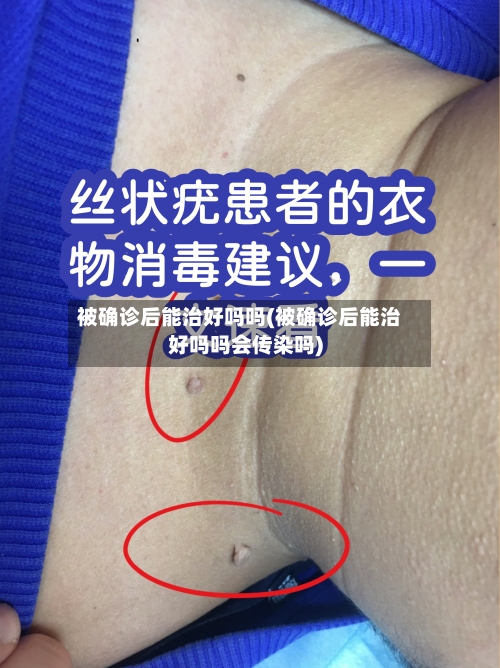 被确诊后能治好吗吗(被确诊后能治好吗吗会传染吗)-第1张图片