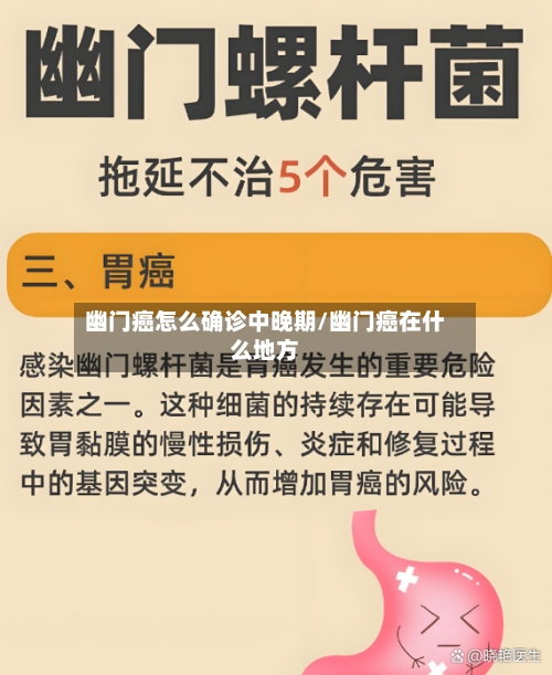 幽门癌怎么确诊中晚期/幽门癌在什么地方-第1张图片
