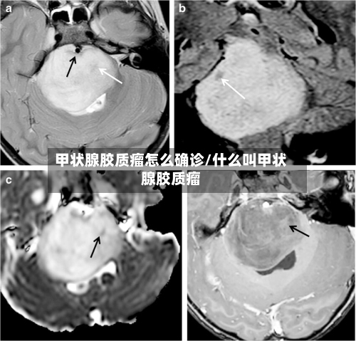 甲状腺胶质瘤怎么确诊/什么叫甲状腺胶质瘤-第1张图片
