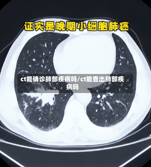 ct能确诊肺部疾病吗/ct能查出肺部疾病吗-第3张图片