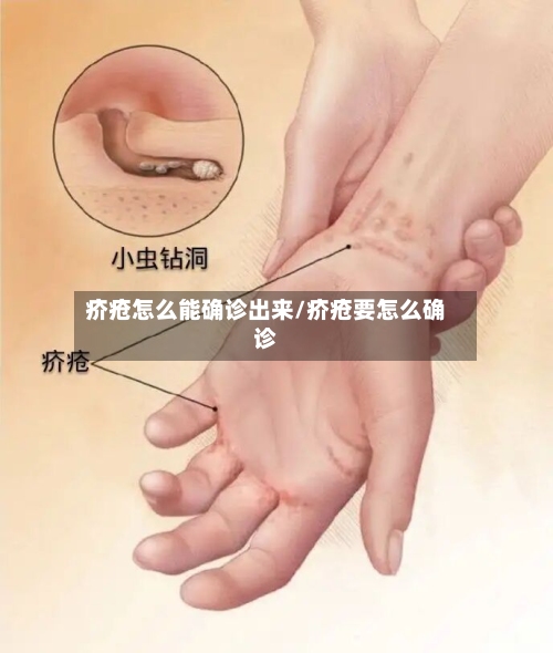 疥疮怎么能确诊出来/疥疮要怎么确诊-第2张图片