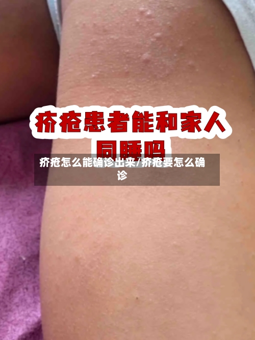 疥疮怎么能确诊出来/疥疮要怎么确诊-第1张图片