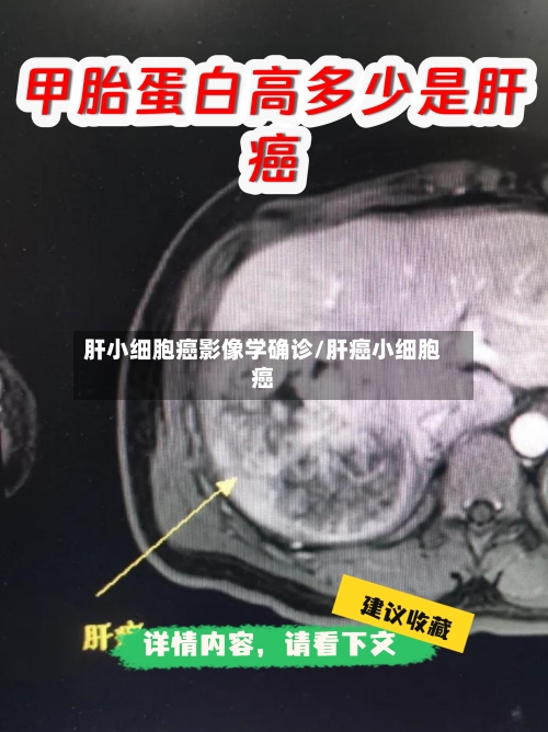 肝小细胞癌影像学确诊/肝癌小细胞癌-第1张图片